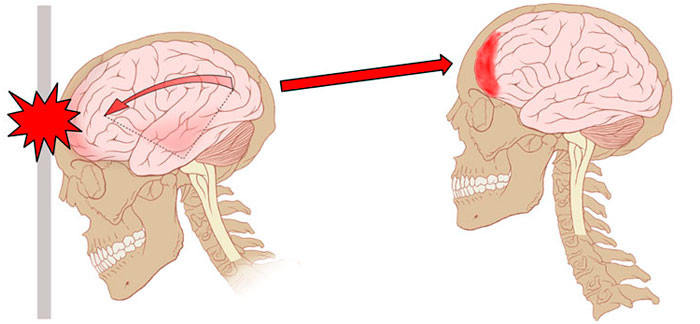 Picture 3 of What should you do when you hit your head hard?