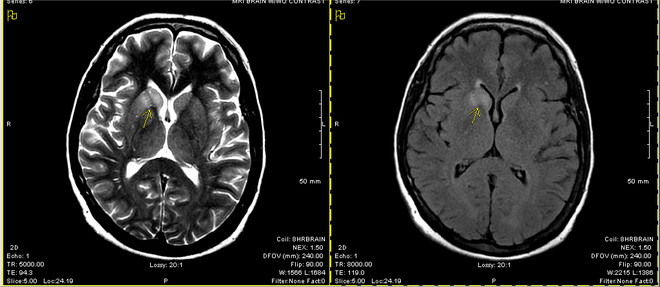 Picture 2 of When white blood cells 'rebellion' and attack the brain itself, this is what happens