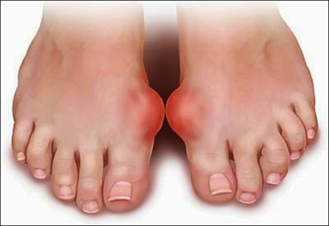 Picture 4 of Where does gout come from?