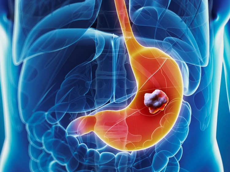 Picture 2 of Which cancer can cause dirty food?