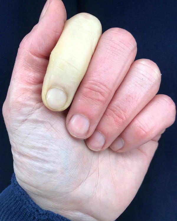 Picture 1 of White fingers warn of dangerous diseases