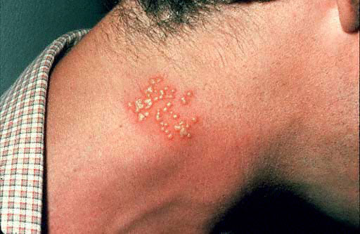 Picture 2 of WHO warns: 50% of the world's population can get Herpes