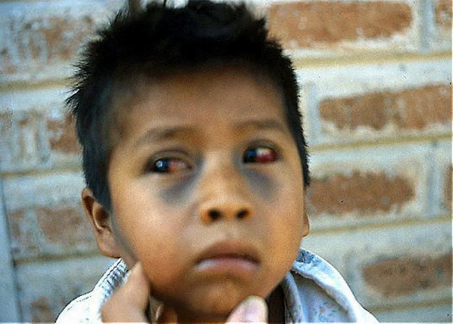Picture 3 of Whooping cough: Causes, transmission, detection, treatment and prevention