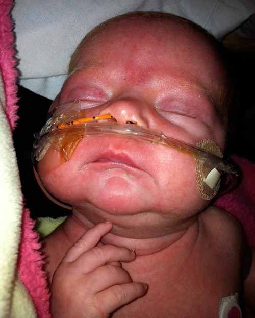 Picture 4 of Whooping cough: Causes, transmission, detection, treatment and prevention