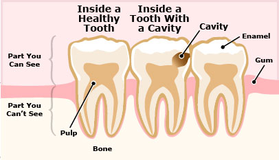 Picture 1 of Why are dental caries no pain and scary as you think?