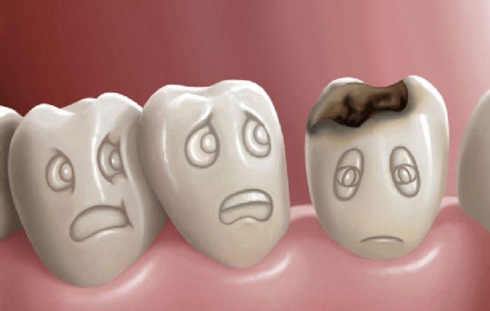 Picture 2 of Why are dental caries no pain and scary as you think?