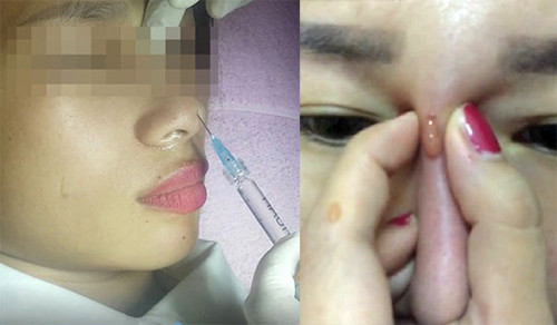Picture 1 of Why can a nose lift or chin fill filler cause complications?