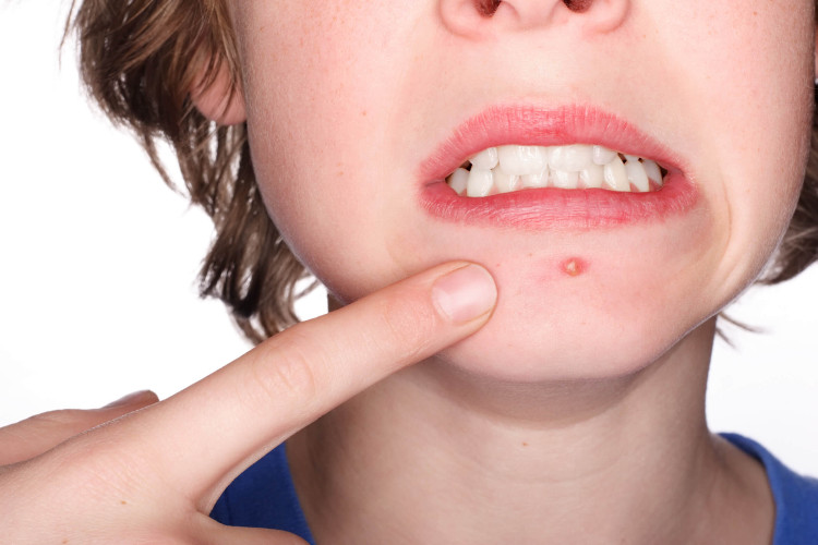 Picture 1 of Why do bacteria cause acne only in some people?