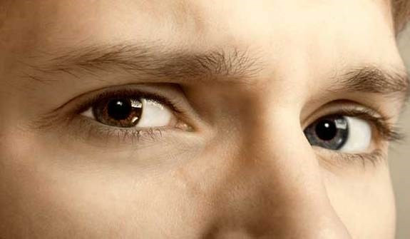 Picture 1 of Why do people have two different eye colors?