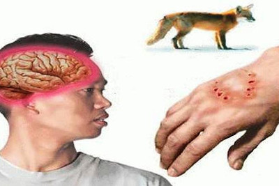 Picture 2 of Why do people who are bitten by rabid dogs get rid of rabies?