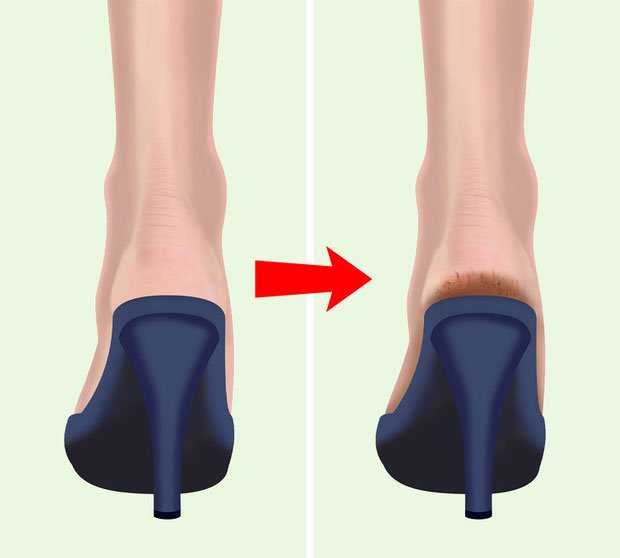 Picture 3 of Why do so many people often have cracked heels?