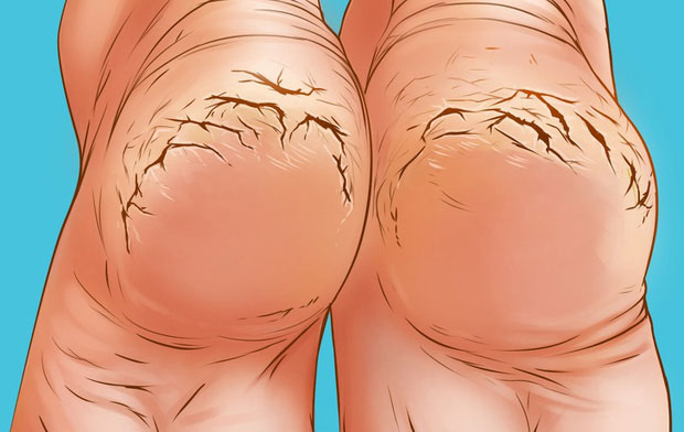 Picture 4 of Why do so many people often have cracked heels?