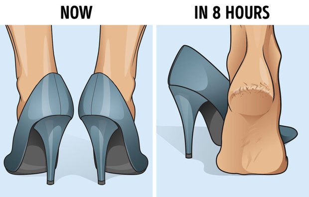 Picture 5 of Why do so many people often have cracked heels?