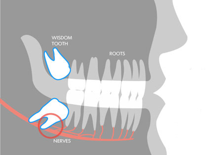 Picture 3 of Why do they grow so stupid they still have the name wisdom teeth?