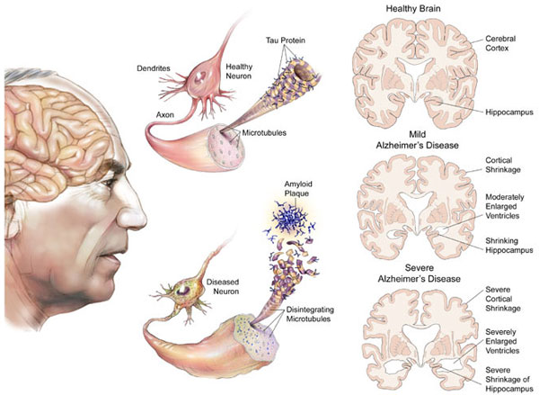 Picture 3 of Why do women have Alzheimer's disease more than men?