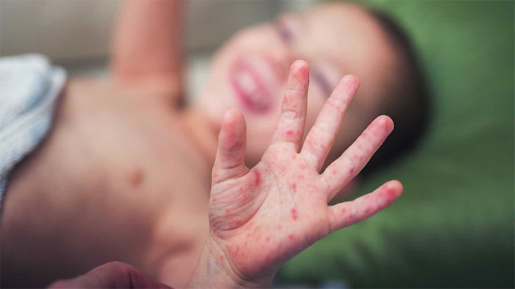 Picture 2 of Why is EV71 virus strain causing hand, foot and mouth disease dangerous to death?