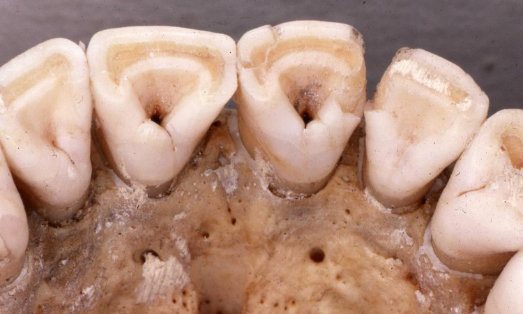 Picture 5 of Why is it that only East Asians and Native Americans have milk teeth shovels?