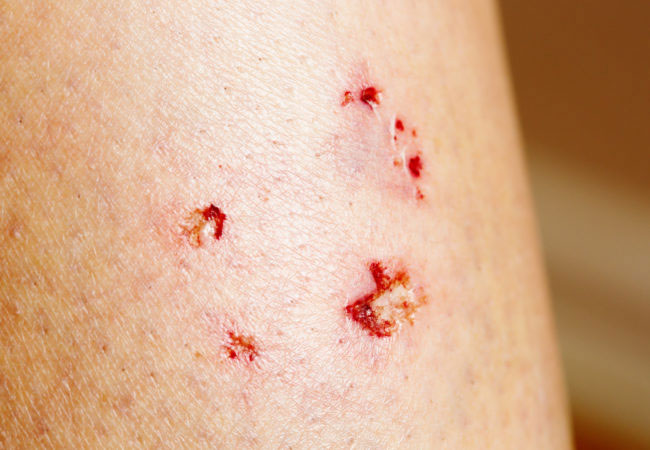Picture 3 of Why only 1 bite can cause blood infection to take one's life?