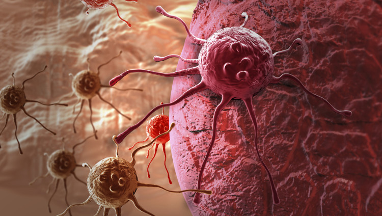 Picture 1 of Young people with cancer are getting more and more and the reason is startling