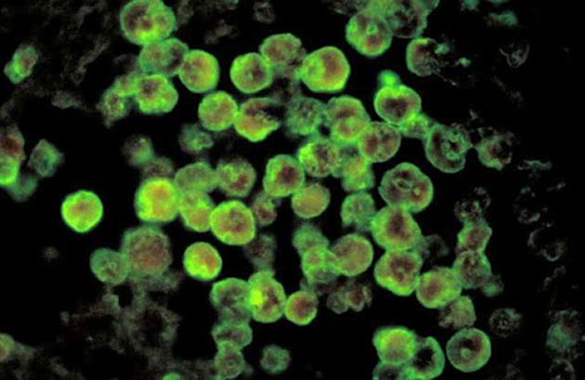 10 deaths due to amoeba feeding on the human brain