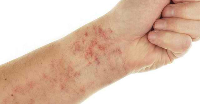 12 warning signs of lupus erythematosus