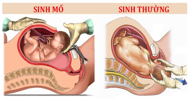 2 benefits and harms of caesarean section compared to normal delivery