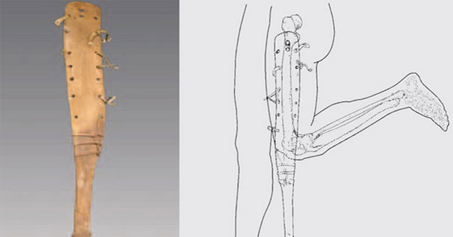 2,200-year-old prosthesis in a tomb in China