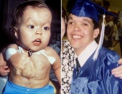 34 years living with a heart outside the chest