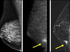 3D ultrasound helps detect breast cancer early