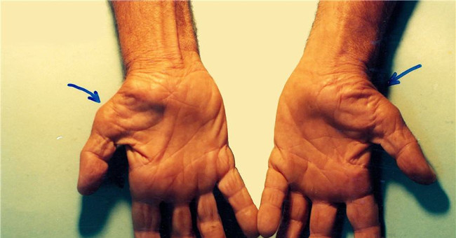3-minute exercise to prevent carpal tunnel syndrome