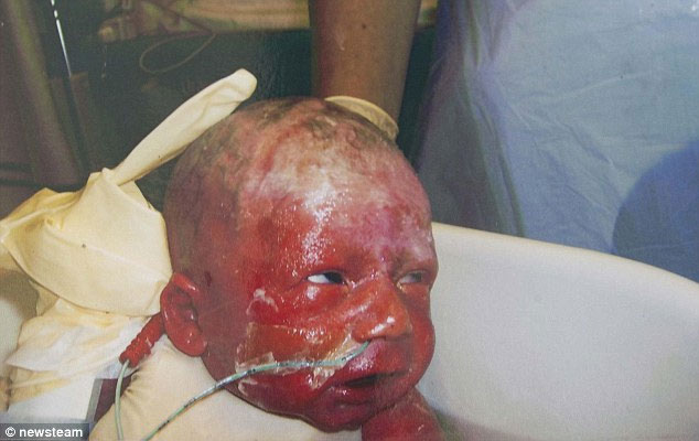 3-year-old baby has red skin