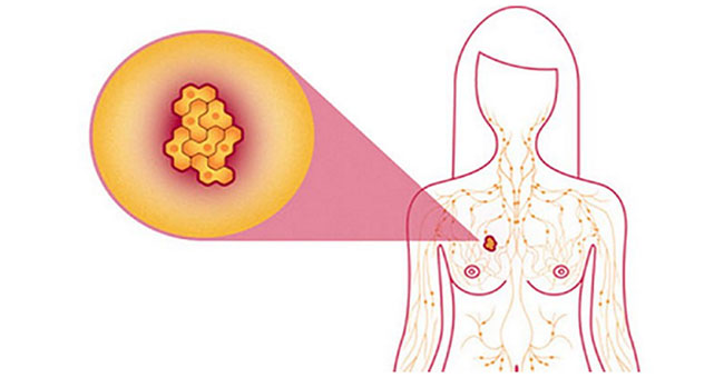 4 daily actions below help reduce the risk of breast cancer