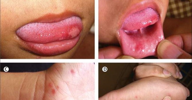 4 mistakes when caring for children with hand, foot and mouth disease
