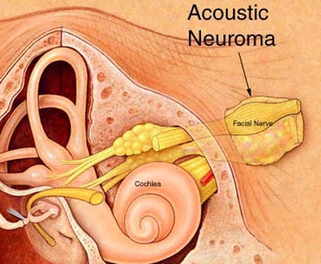 4 perpetrators suddenly caused hearing loss