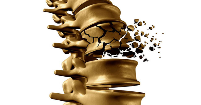 4 signs 'silently' warning of osteoporosis