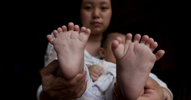 4-month-old baby has 31 fingers