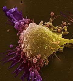 5 gene variants related to prostate cancer