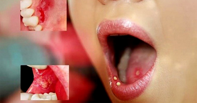 7 signs of 'sneaking' on oral cancer