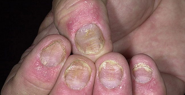 8 main causes of psoriasis