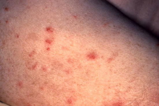 83 people died in the US syphilis experiment