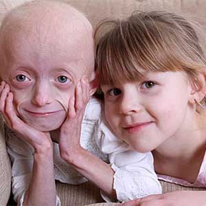 8-year-old baby got strange disease, his face was like an 80-year-old woman