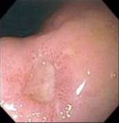9 frequently asked questions about peptic ulcer disease