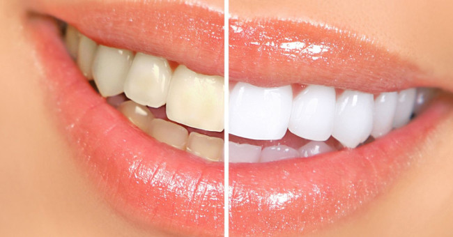 9 ways to make teeth white