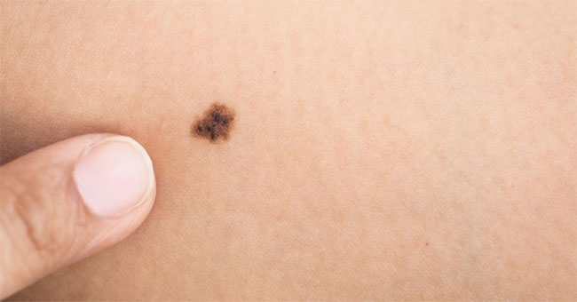 A cancer vaccine gives 100% efficiency in mouse testing