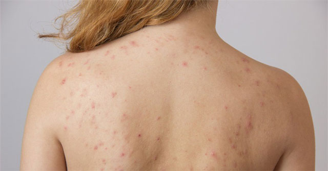 A lot of acne can be a sign of the following 4 health problems