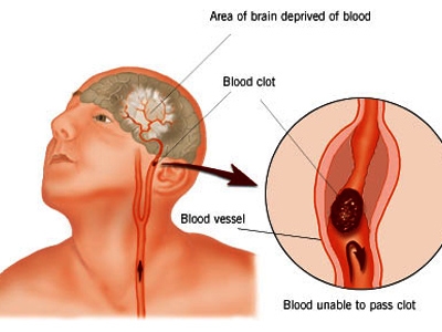 A new way of looking at stroke