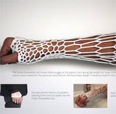 A new way to treat broken bones: Bundle with 3D print material