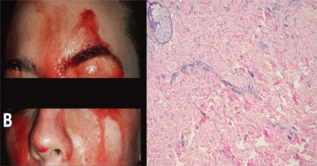 A rare rare illness caused this girl to shed blood instead of sweat