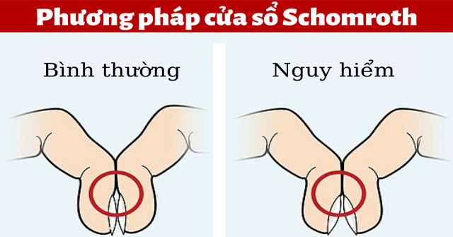 A simple operation with your finger can tell if you have lung cancer or not