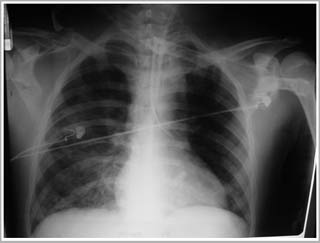 A urine test helps predict lung damage